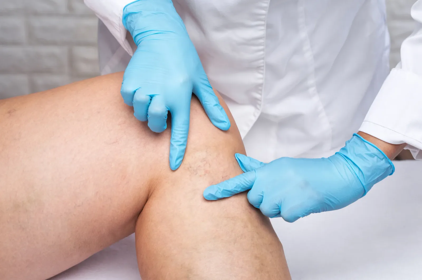 Chronic venous insufficiency condition