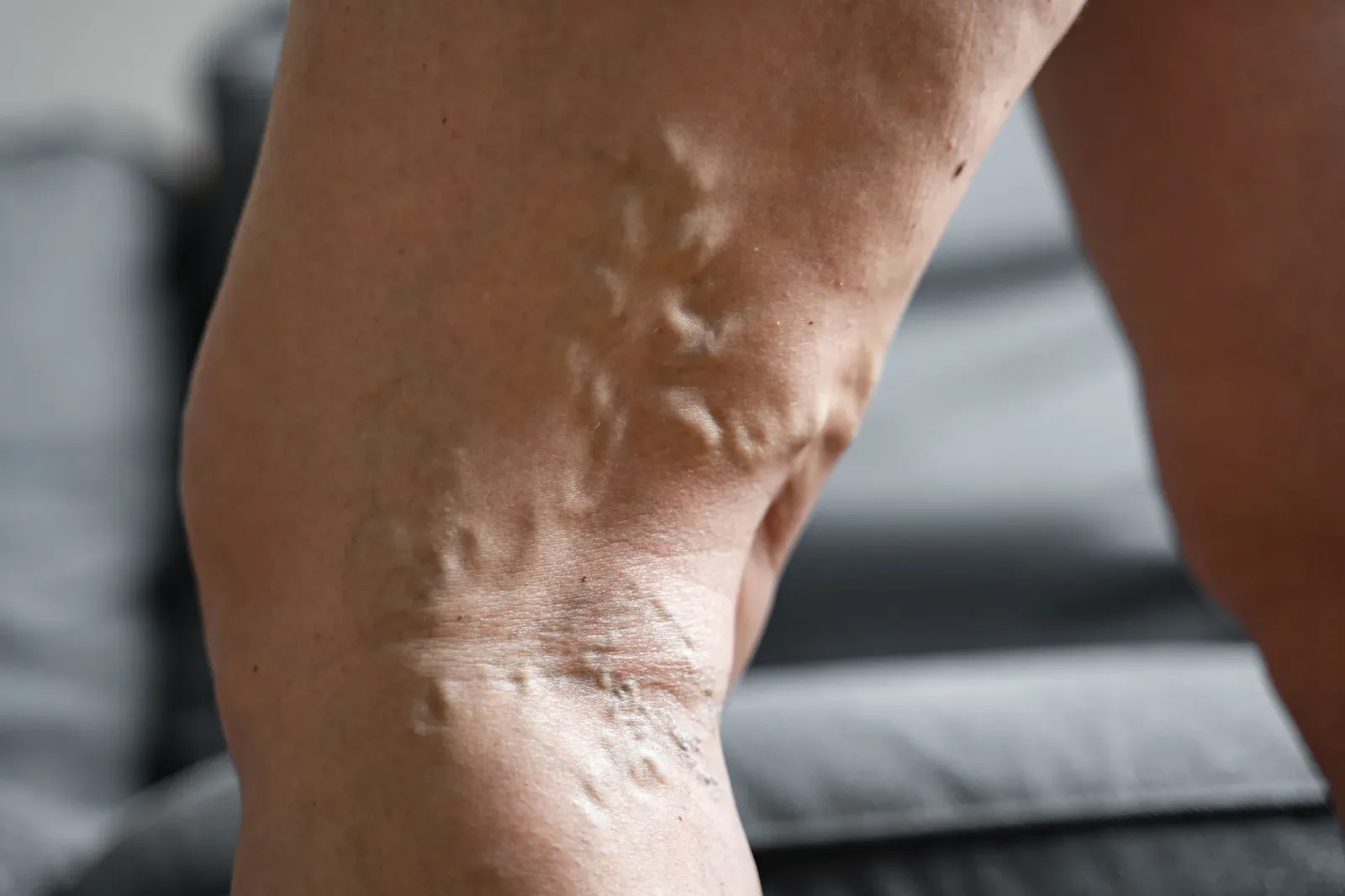 Doctor examining varicose veins on patient's leg